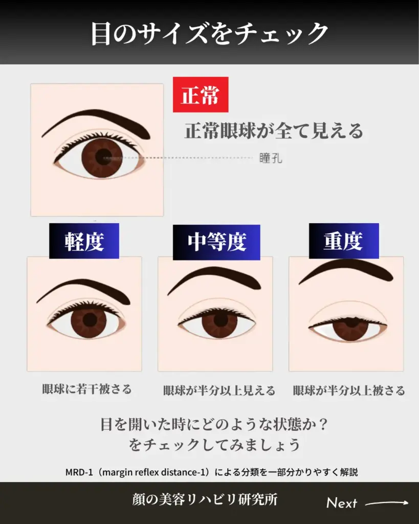 目の大きさ・眼瞼下垂簡易チェック