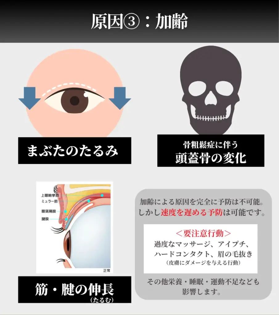 加齢によるまぶたのたるみ