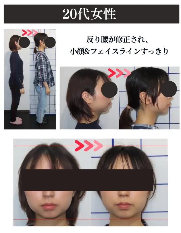 福岡の触らない小顔矯正事例１