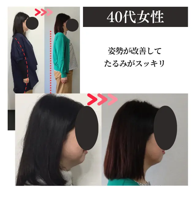 福岡の触らない小顔矯正事例3