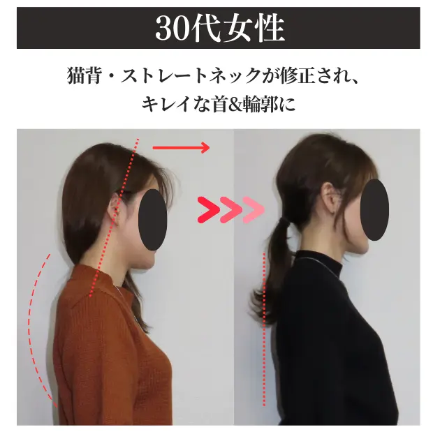 福岡の触らない小顔矯正事例2