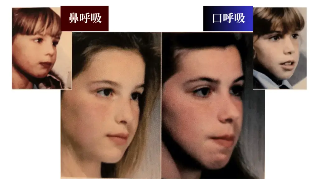 口呼吸と鼻呼吸の違いが顔に影響する