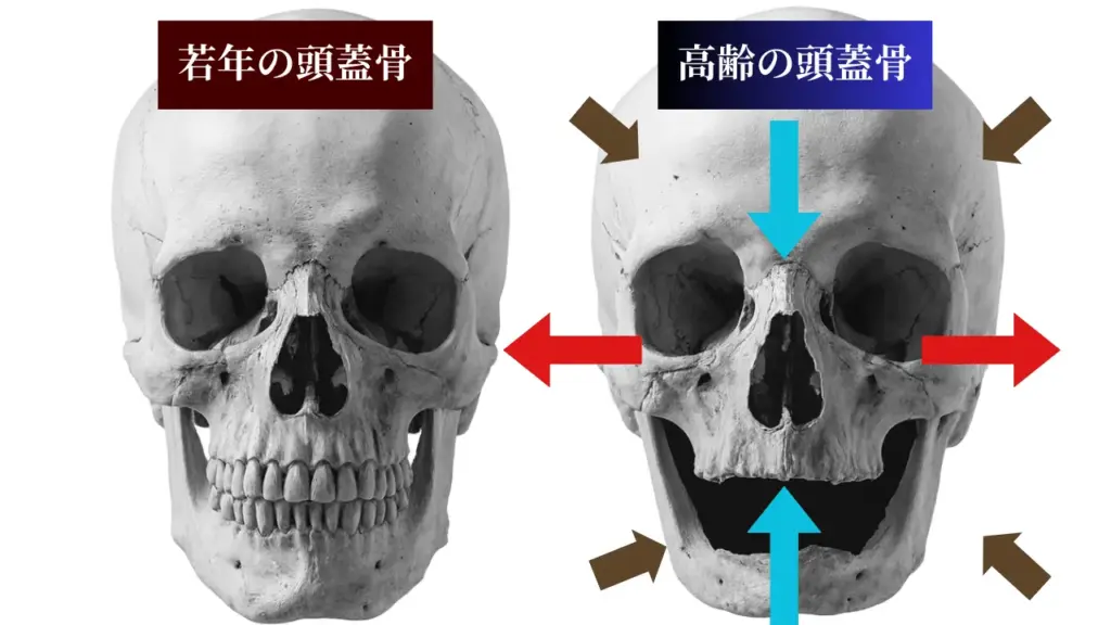 頭蓋骨の年齢・加齢による変形