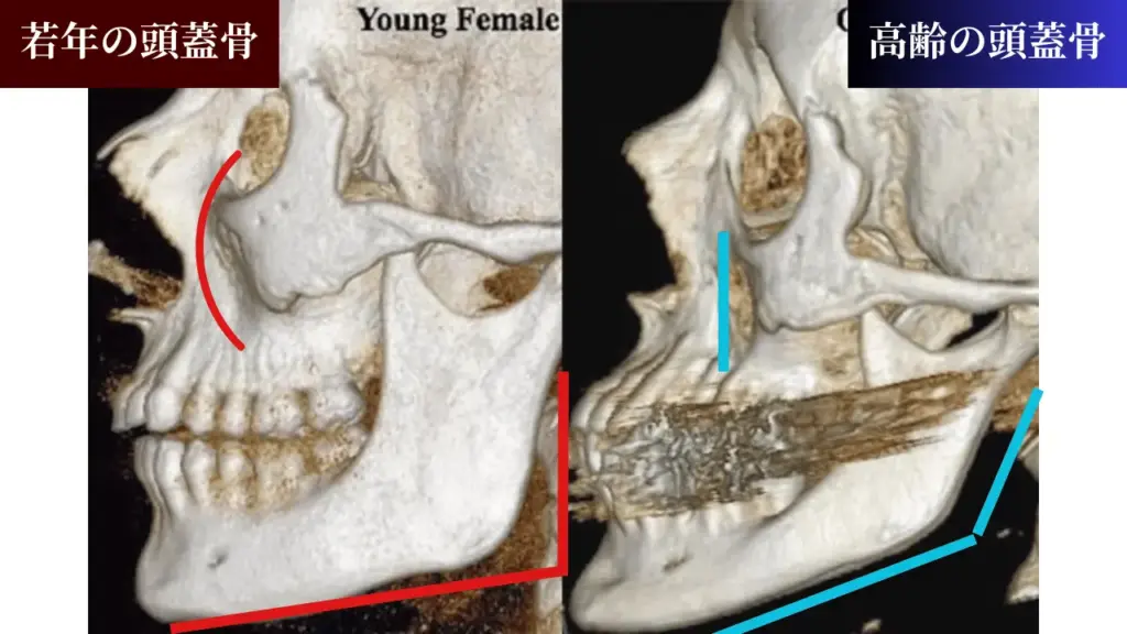 頭蓋骨の加齢変化（CT）