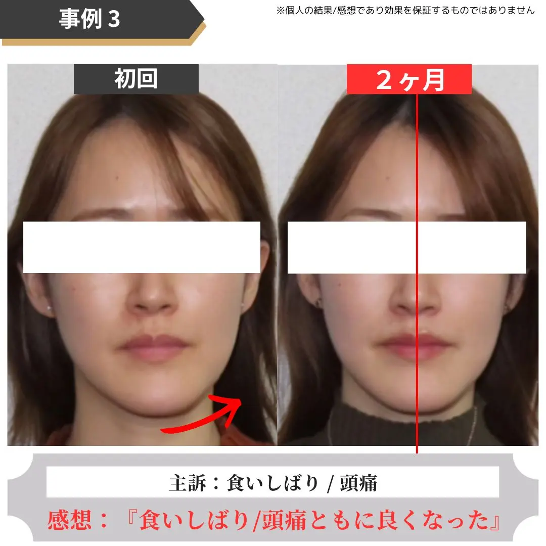 顎関節症のお客様の事例3