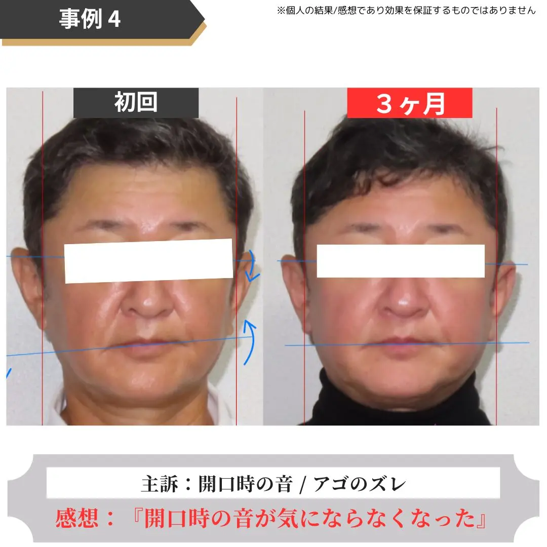 顎関節症のお客様の事例4