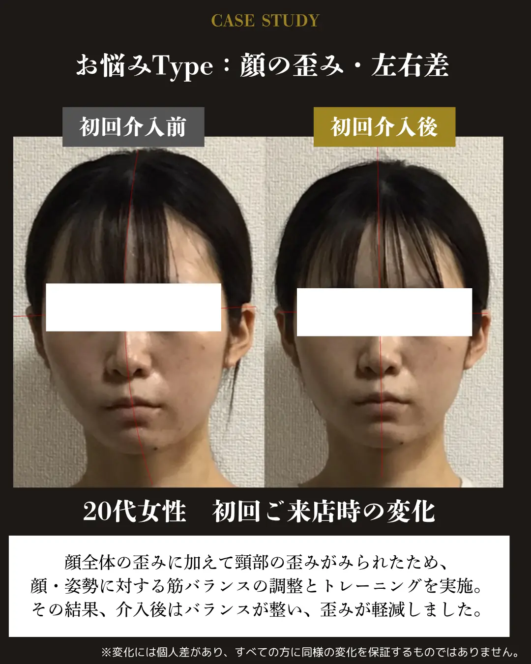 20代女性の顔の歪み・左右差。初回介入前後の正面顔を比較した事例カード
