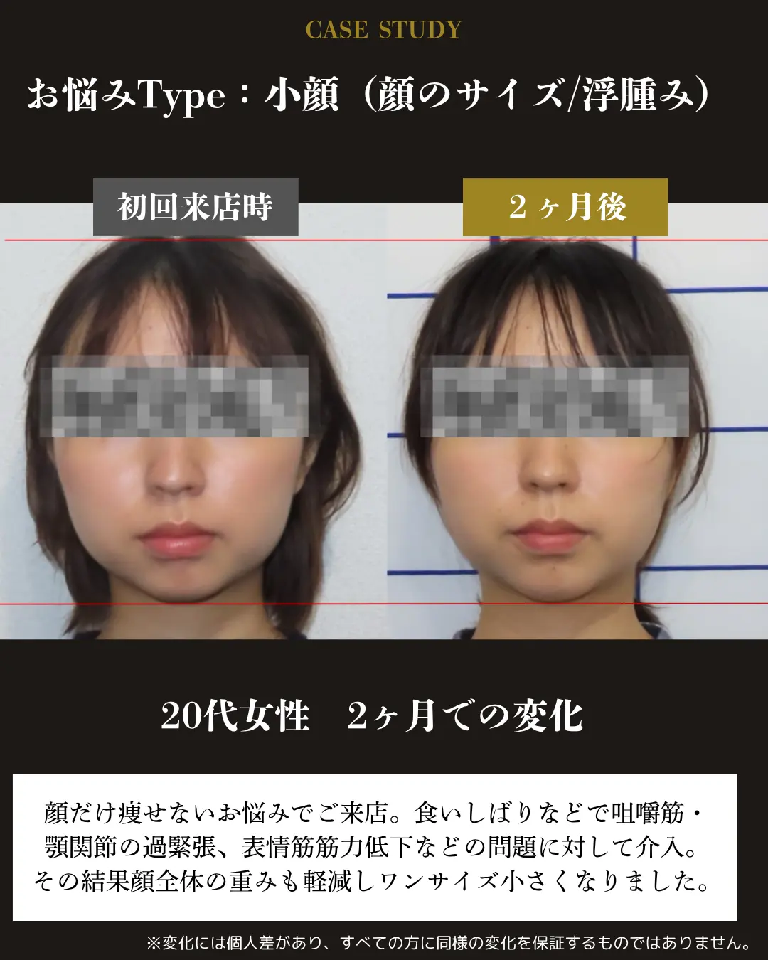 20代女性の顔のサイズとむくみ。初回来店時と2か月後の正面顔を比較した事例カード