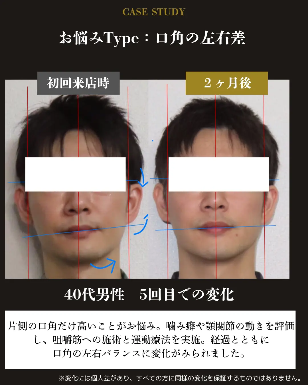 40代男性の口角の左右差。初回来店時と2か月後の正面顔を比較した事例カード