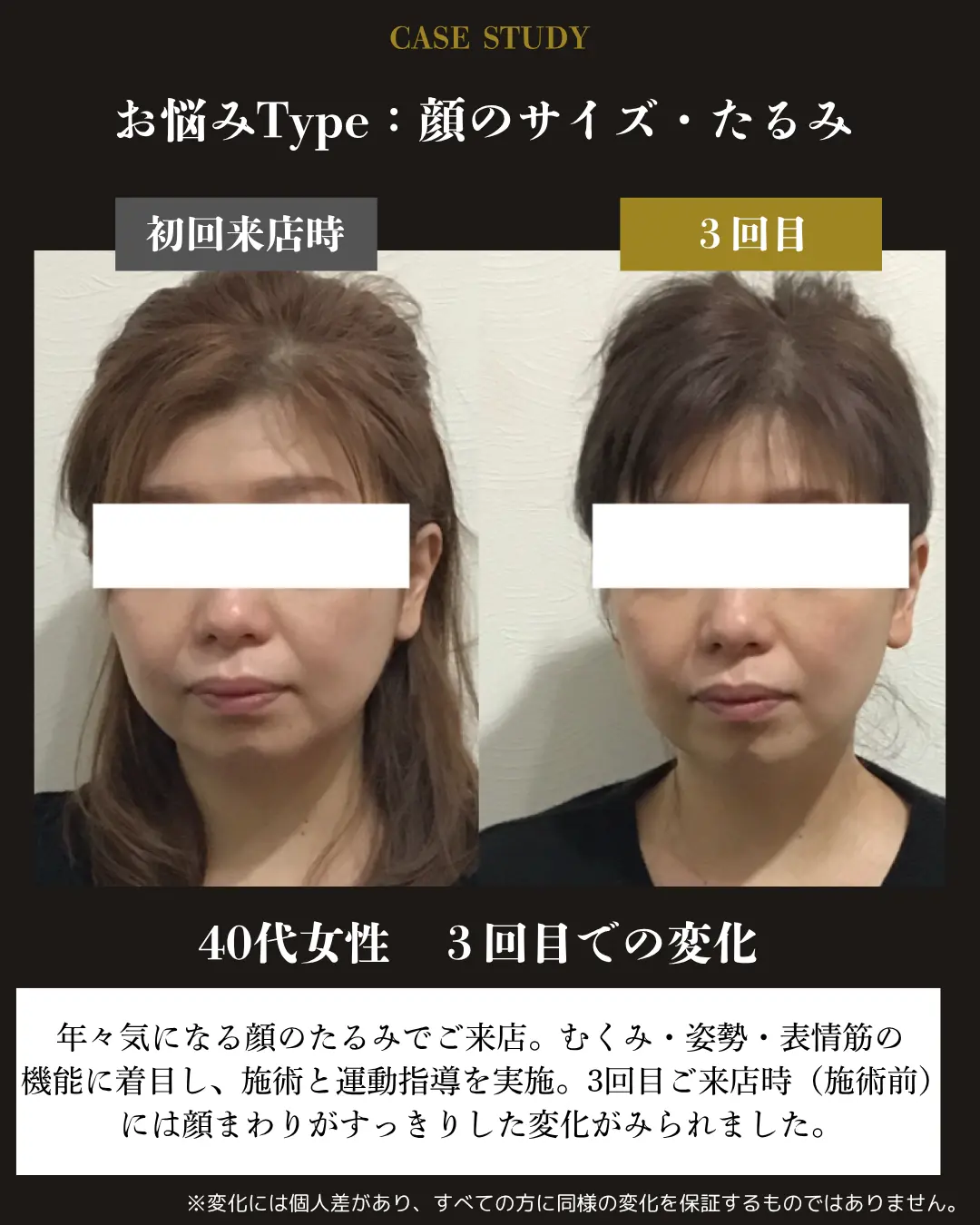 40代女性の顔まわりのたるみ。初回来店時と3回目の施術前を比較した事例カード