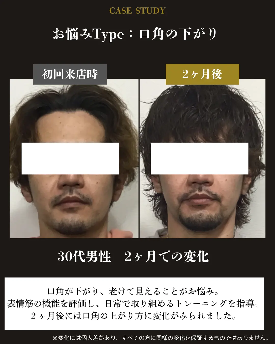 30代男性の口角の下がり。初回来店時と2か月後の正面顔を比較した事例カード