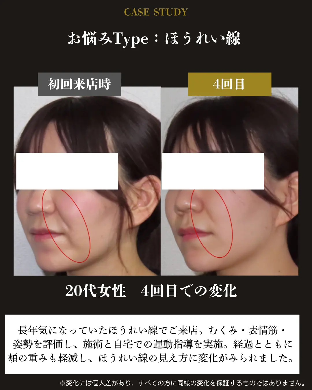 20代女性のほうれい線。初回来店時と4回目の頬・口元を比較した事例カード