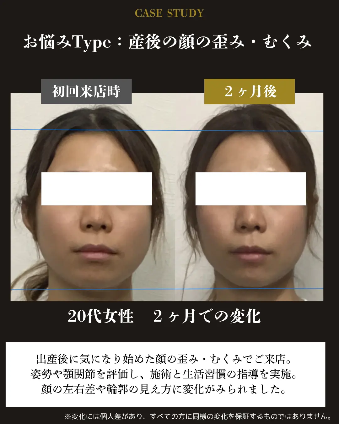 20代女性の産後の顔の歪み・むくみ。初回来店時と2か月後の正面顔を比較した事例カード
