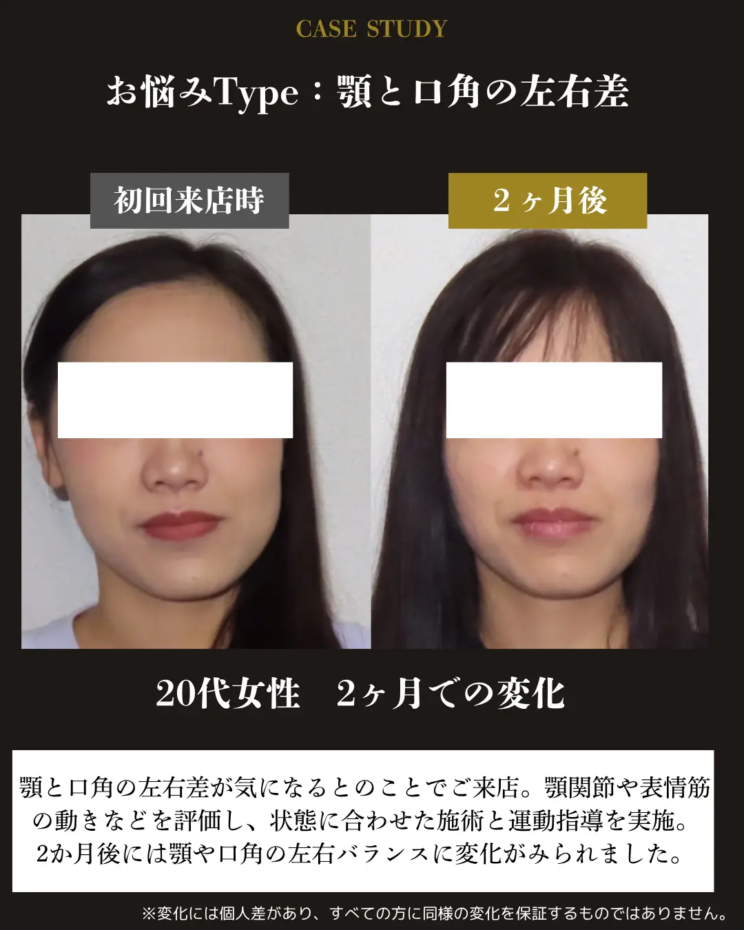 20代女性の顎と口角の左右差。初回来店時と2か月後の正面顔を比較した事例カード