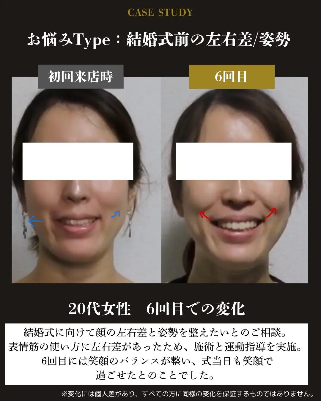 結婚式前に顔の左右差を相談した20代女性。初回来店時と6回目の笑顔を比較した事例カード