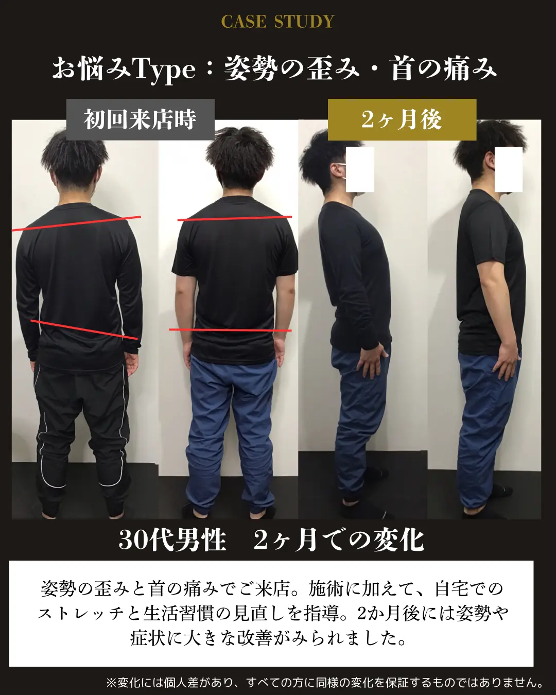 30代男性の姿勢の歪みと首の痛み。初回来店時と2か月後の背面・側面写真を比較した事例カード
