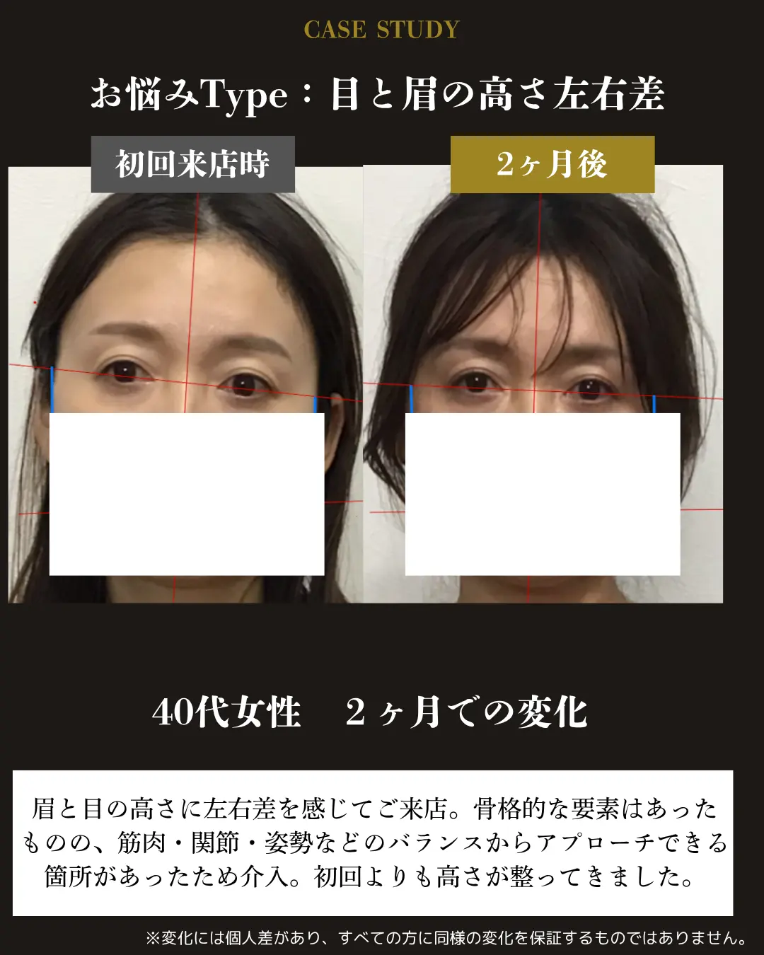 40代女性の目と眉の高さの左右差。初回来店時と2か月後を比較した事例カード
