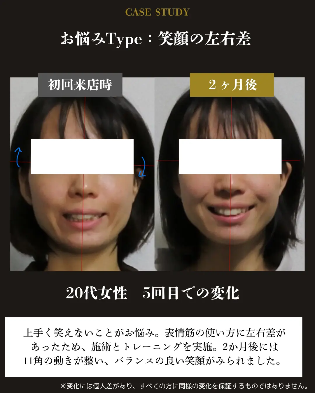 20代女性の笑顔の左右差。初回来店時と2か月後の笑顔を比較した事例カード