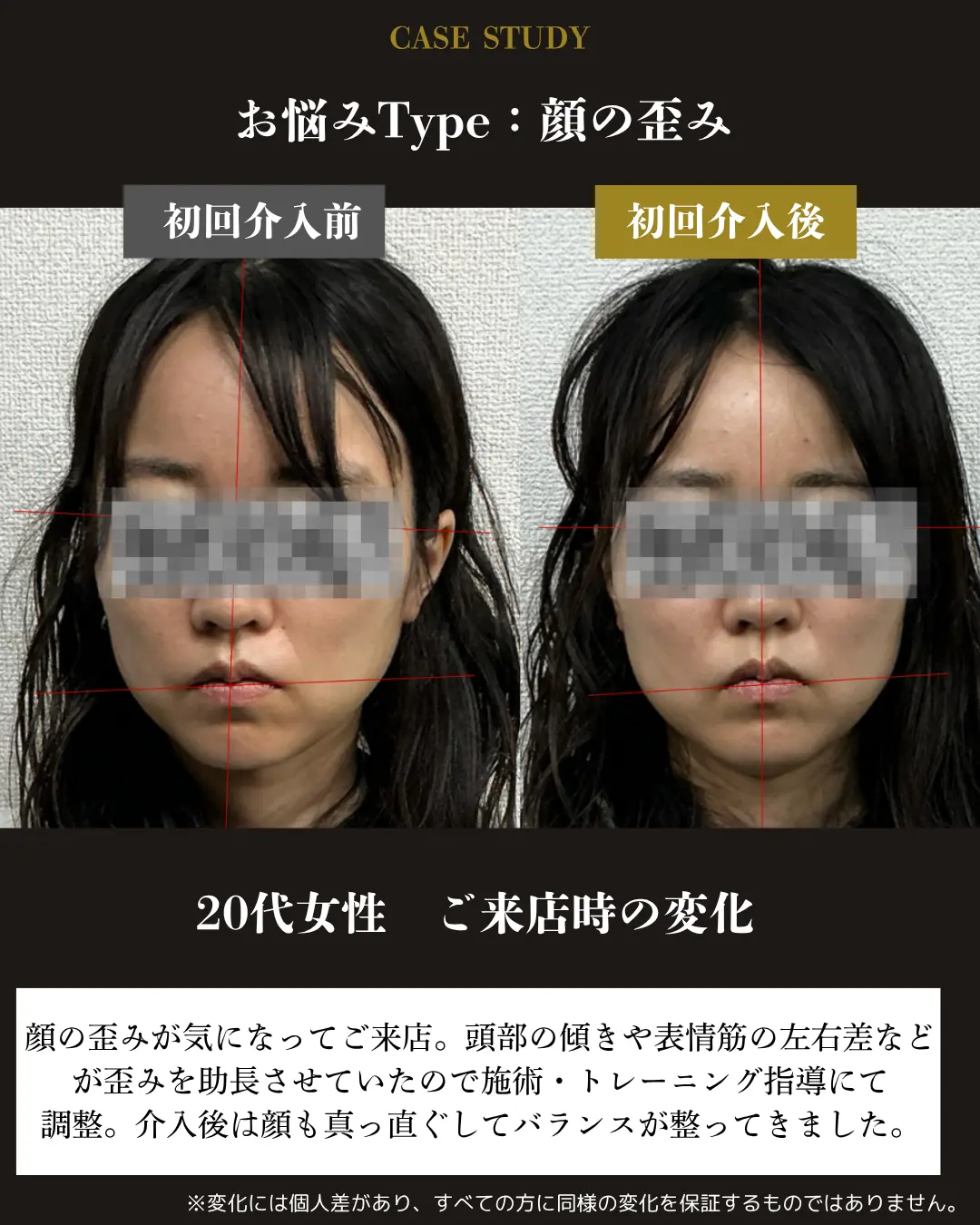 20代女性の顔の歪み。初回介入前後の正面顔写真を比較した事例カード