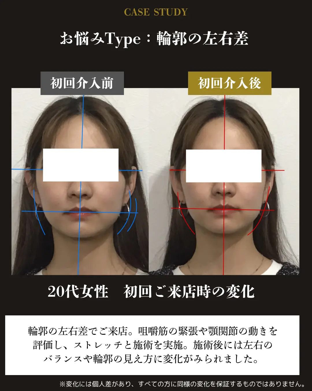 20代女性の輪郭の左右差。初回介入前後の正面顔を比較した事例カード