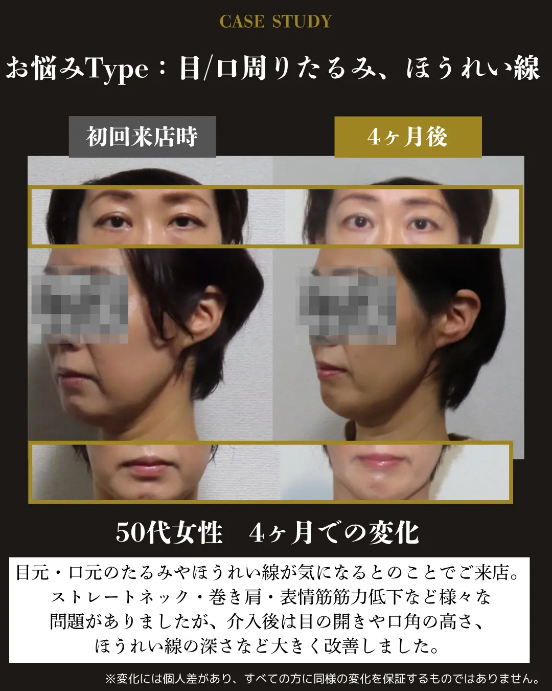 50代女性の目元・口元のたるみとほうれい線。初回来店時と4か月後を比較した事例カード