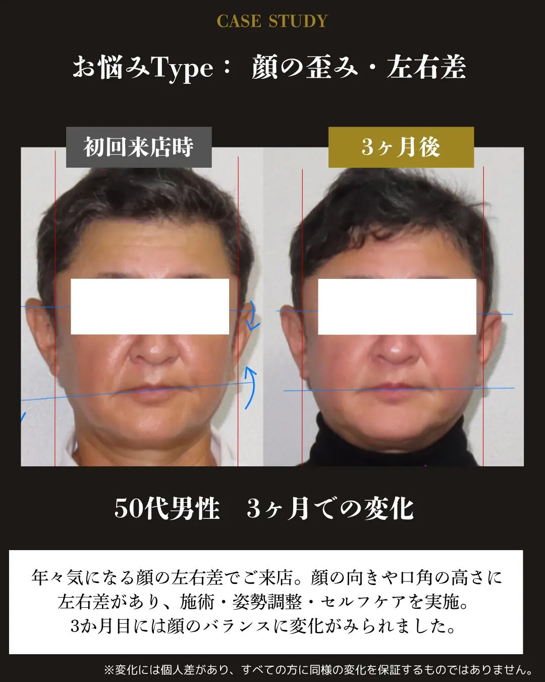 50代男性の顔の左右差。初回来店時と3か月後の正面顔を比較した事例カード