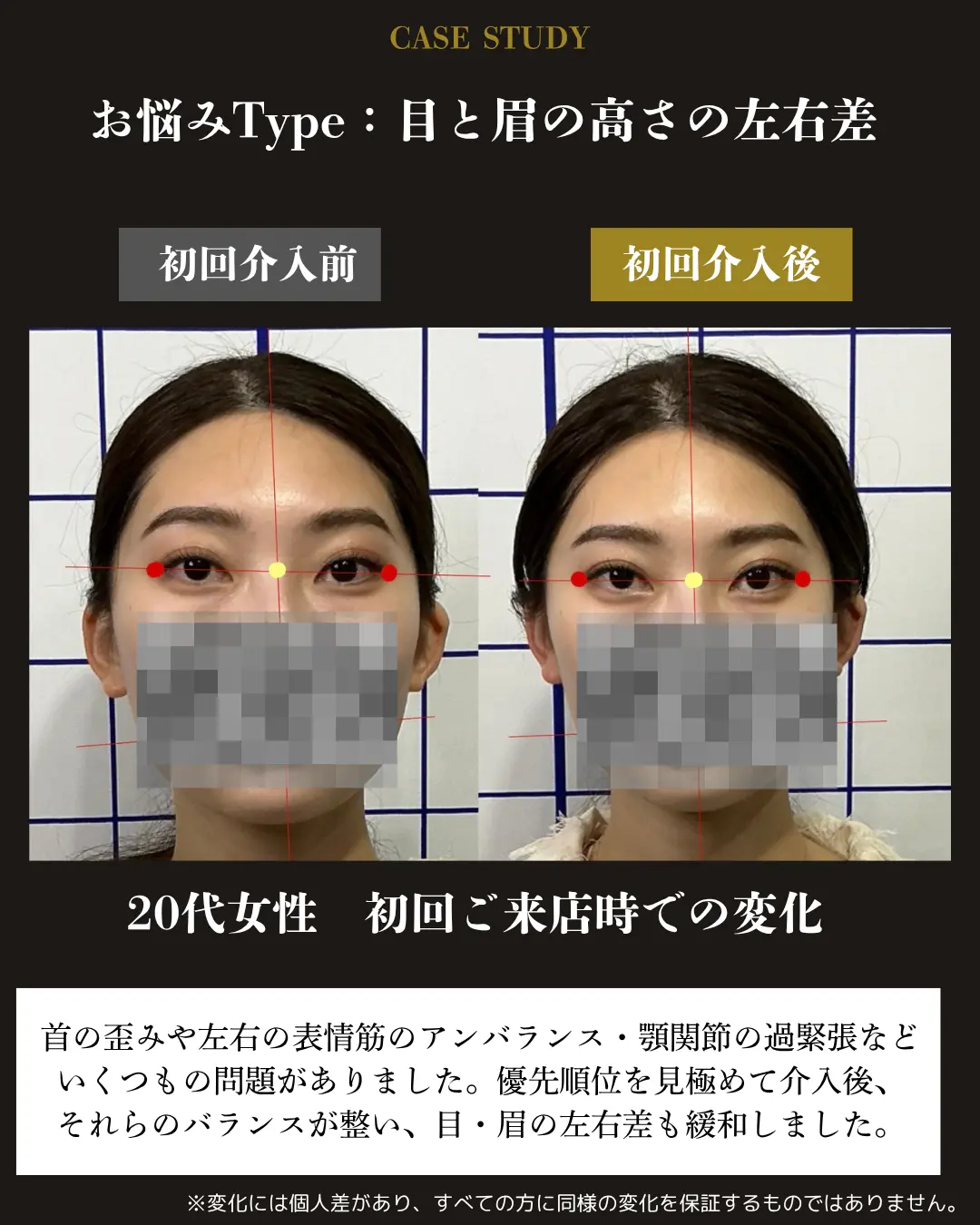 20代女性の目と眉の高さの左右差。初回介入前後の正面顔を比較した事例カード