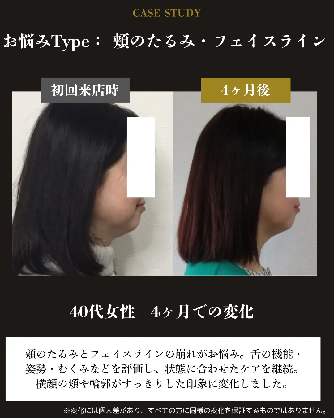 40代女性の頬のたるみとフェイスライン。初回来店時と4か月後の横顔を比較した事例カード