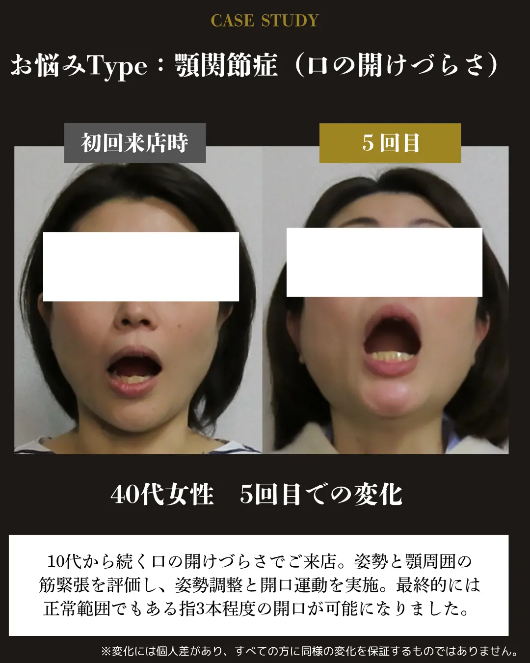 40代女性の口の開けづらさ。初回来店時と5回目の開口状態を比較した事例カード