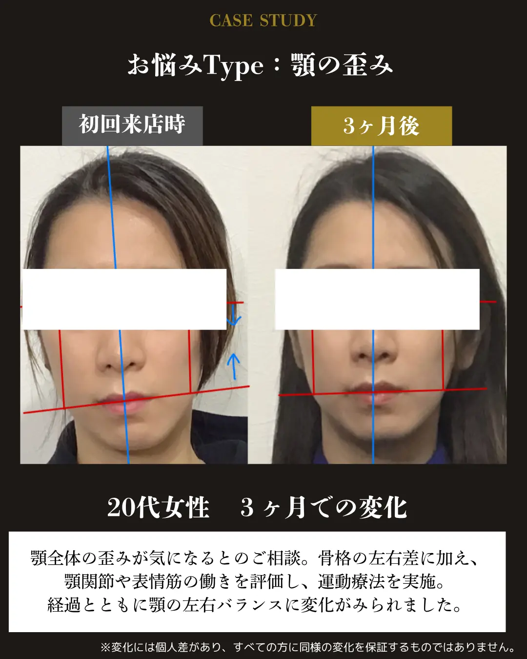20代女性の顎の歪み。初回来店時と3か月後の顎の左右バランスを比較した事例カード